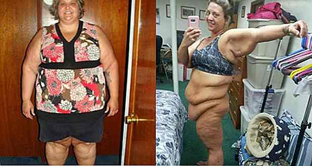 Obesa di 36 anni perde 81 kg grazie alla terapia per il controllo emotivo