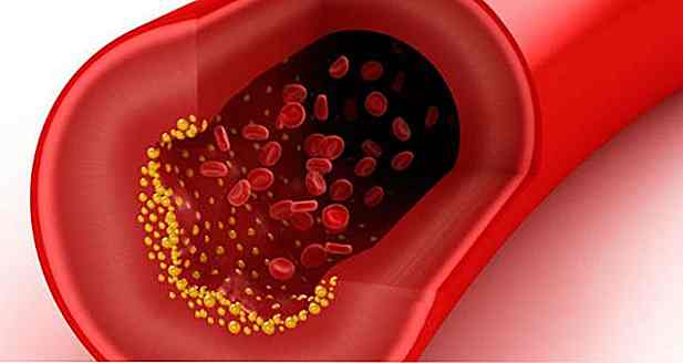 Hypercholestérolémie familiale - symptômes, diagnostic et traitement