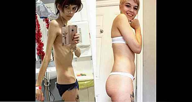 Young batte anoressia e mostra la trasformazione per aiutare gli altri