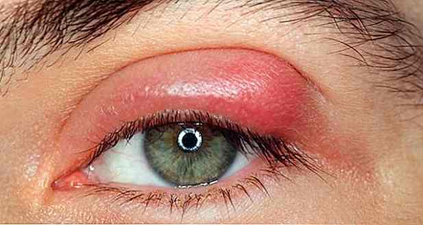 Comment traiter les sourcils?  Est-ce contagieux?  Causes, symptômes et quoi faire