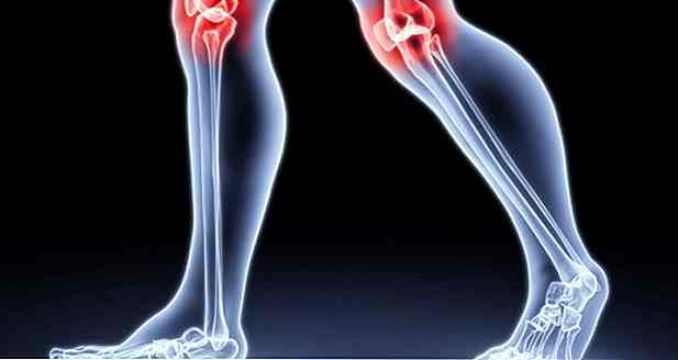 Ist Arthrose Heilung?  Was es ist, Symptome und Behandlung